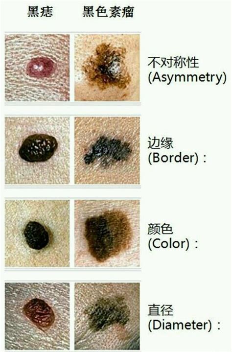 身上有很多痣|哪些痣会癌变？脸上的痣能点吗？专家这回终于说清楚了